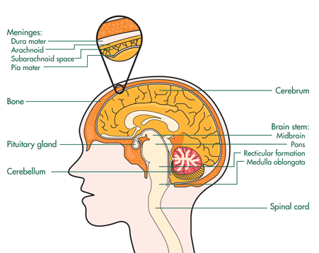 Subarachnoid Haemorrhage